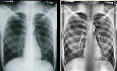 Chest X-ray.jpg